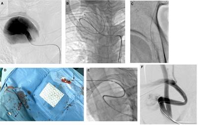 Endovascular Repair for Giant Right Subclavian Artery Aneurysm With Gore Viabahn and Pull-Through Procedure: A Case Report